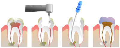 400px Root Canal Illustration Molar.svg